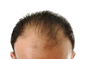 man with hair loss